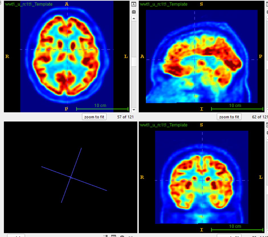 MRI Scan