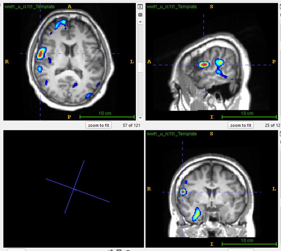 MRI Scan