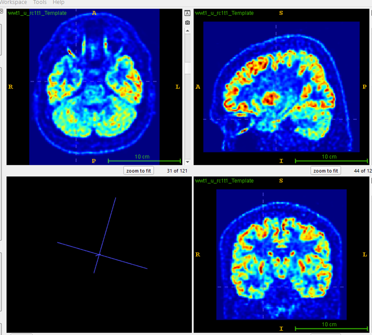 MRI Scan