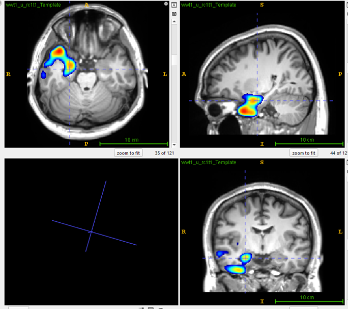 MRI Scan